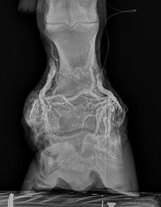 Foot X-Ray Front View
